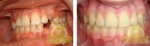 До и после ортодонтического лечения в клинике «ДентаЛюкс-М»