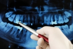 Рентгенологический снимок зубного налета